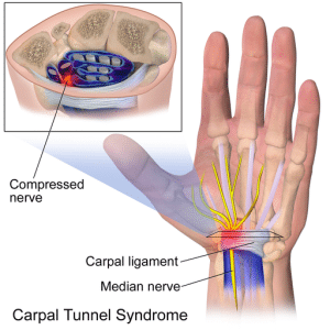 hand and wrist with carpal tunnel