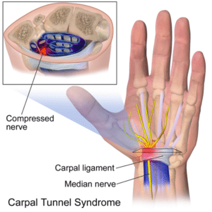 Carpal-Tunnel-Syndrome