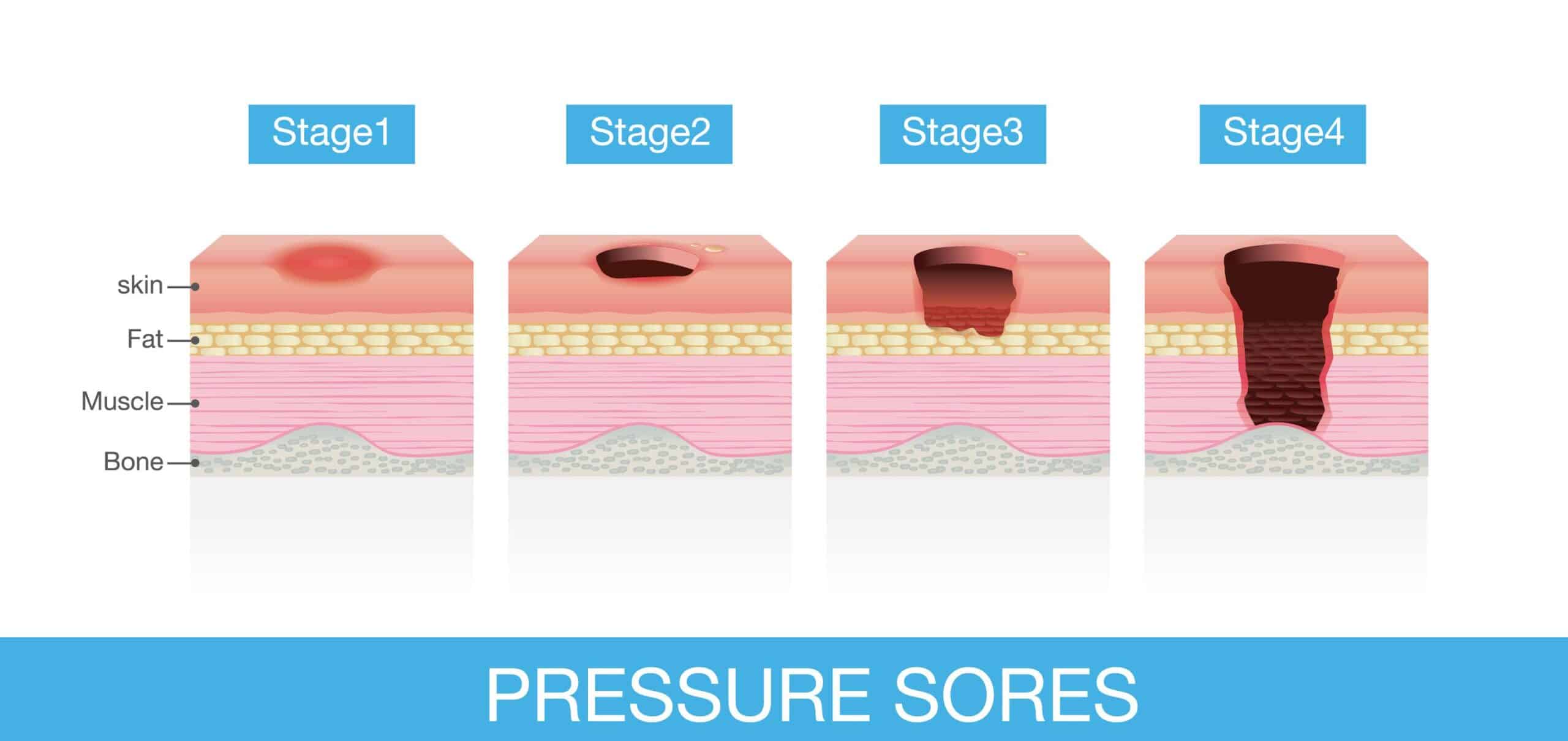 Stages of Pressure Sores