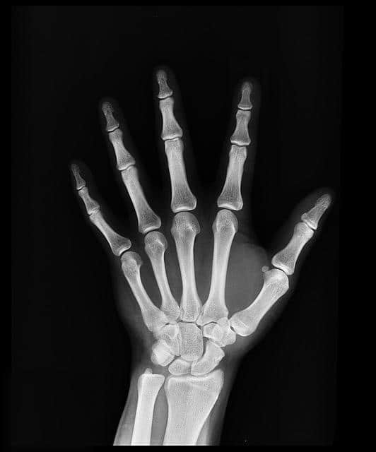 Photo of Xray of a Hand